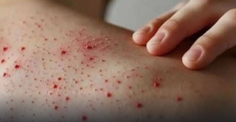 OPS concede prórroga de dos meses a México para frenar brote de sarampión